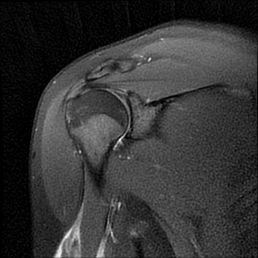 Biceps Brachii Long Head Tendon Rupture Image 5818