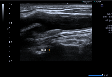 Carotid Artery Stenosis Radiology Case Radiopaedia Org