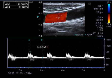 Carotid artery stenosis | Image | Radiopaedia.org