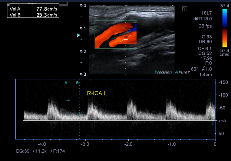 Carotid artery stenosis | Image | Radiopaedia.org