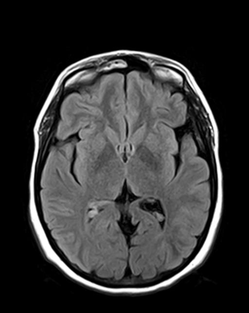 Brain metastases from breast cancer | Image | Radiopaedia.org