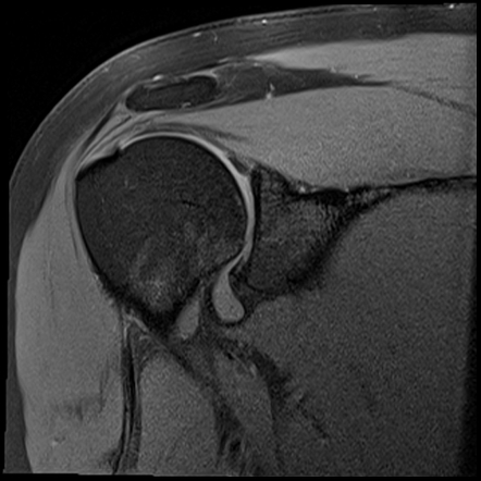 Normal shoulder MRI arthrogram | Image | Radiopaedia.org