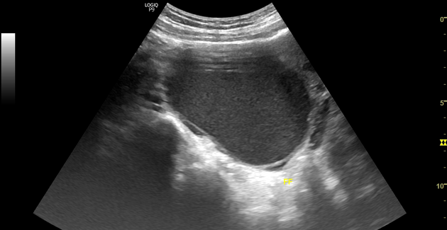 Endometrioma | Radiology Reference Article | Radiopaedia.org