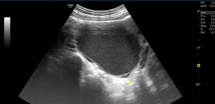 Endometrioma | Radiology Reference Article | Radiopaedia.org