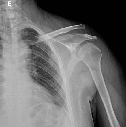 Acromioclavicular joint injury - Rockwood type III | Radiology Case ...