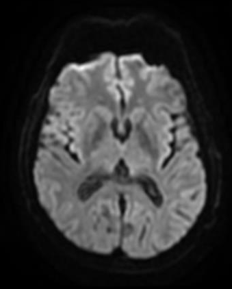 Retention cyst of Rosenmüller fossa | Image | Radiopaedia.org