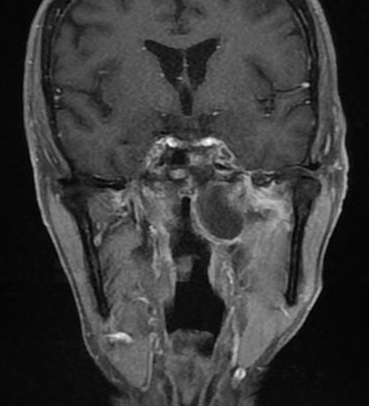 Retention cyst of Rosenmüller fossa | Image | Radiopaedia.org