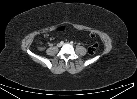 Peritoneal loose body | Radiology Case | Radiopaedia.org