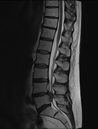 Massive lumbar disc extrusion | Image | Radiopaedia.org