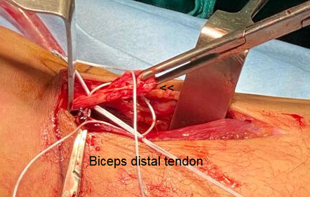 distal biceps tendonitis