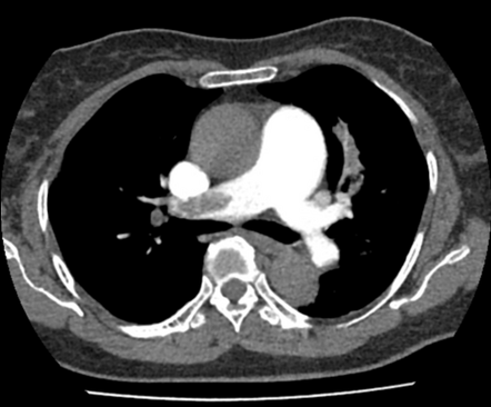 Bilateral pulmonary embolism and vacuum assisted thrombectomy ...