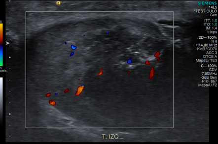 Adrenal rests | Image | Radiopaedia.org