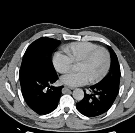 Azygos Continuation Of Inferior Vena Cava 