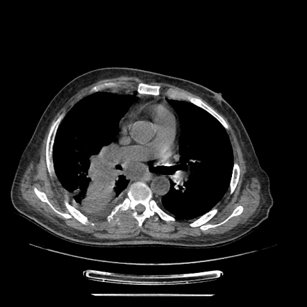 Metastasizing lung cancer | Radiology Case | Radiopaedia.org