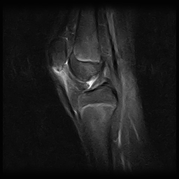 Sinding-Larsen-Johansson disease | Image | Radiopaedia.org