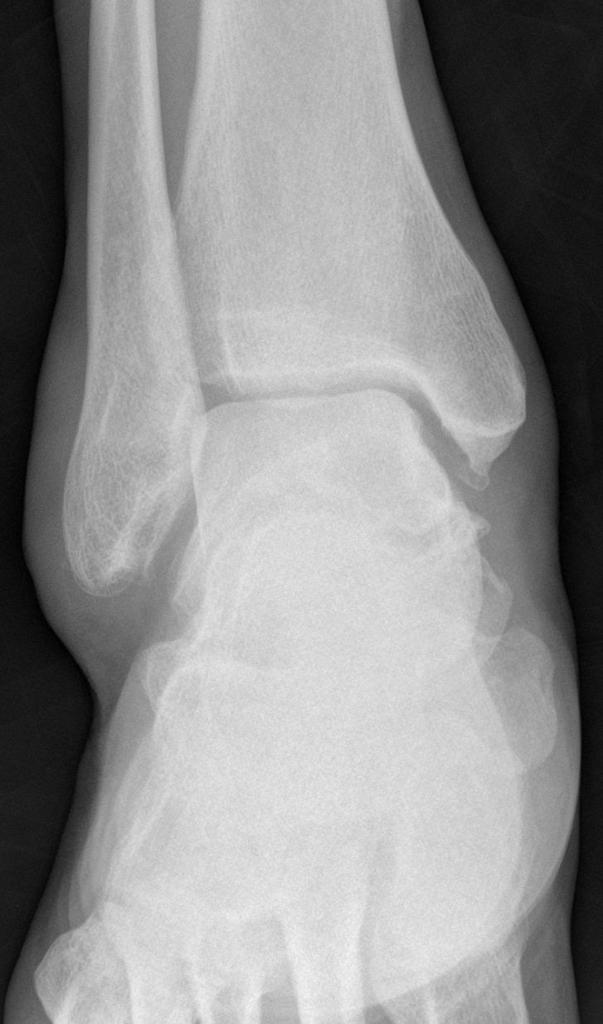 Malleolus Medialis Hangi Kemikte Bulunur - Medial Malleolus Ossicle Radiology Case Radiopaedia