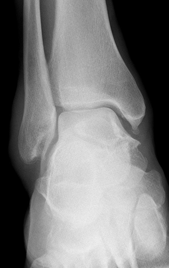 Medial malleolus ossicle | Image | Radiopaedia.org