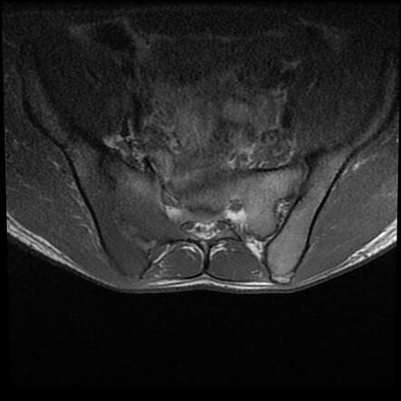 Sacroiliitis - Brucella | Image | Radiopaedia.org