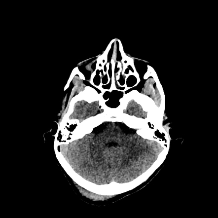 Temporal bone fracture | Image | Radiopaedia.org