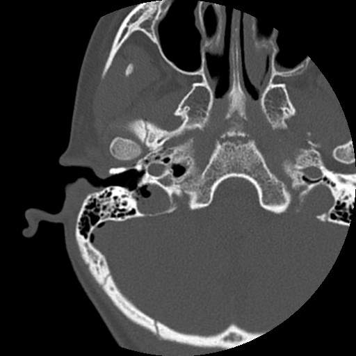 Temporal bone fracture | Image | Radiopaedia.org