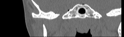 Temporal Bone Fracture Image