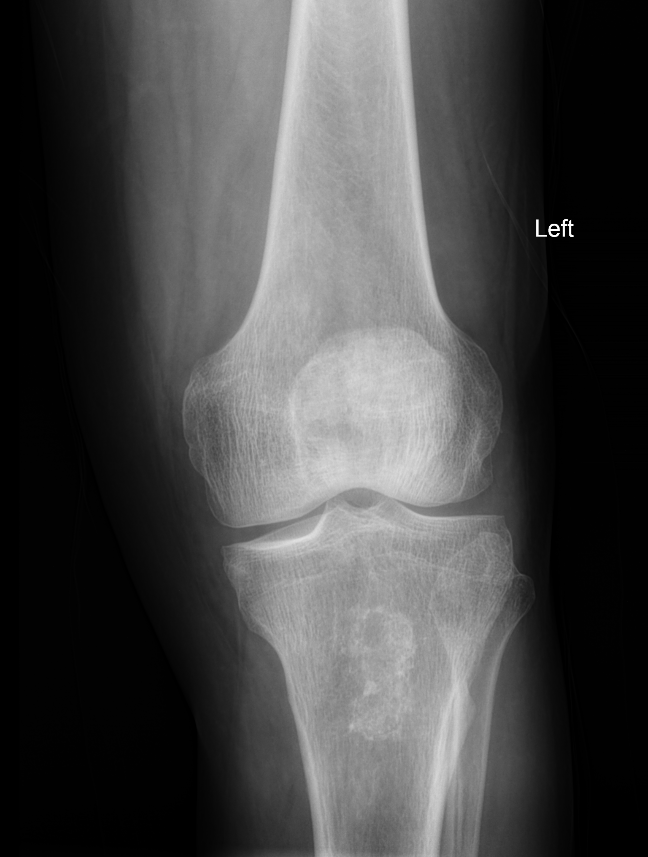 Enchondroma | Image | Radiopaedia.org