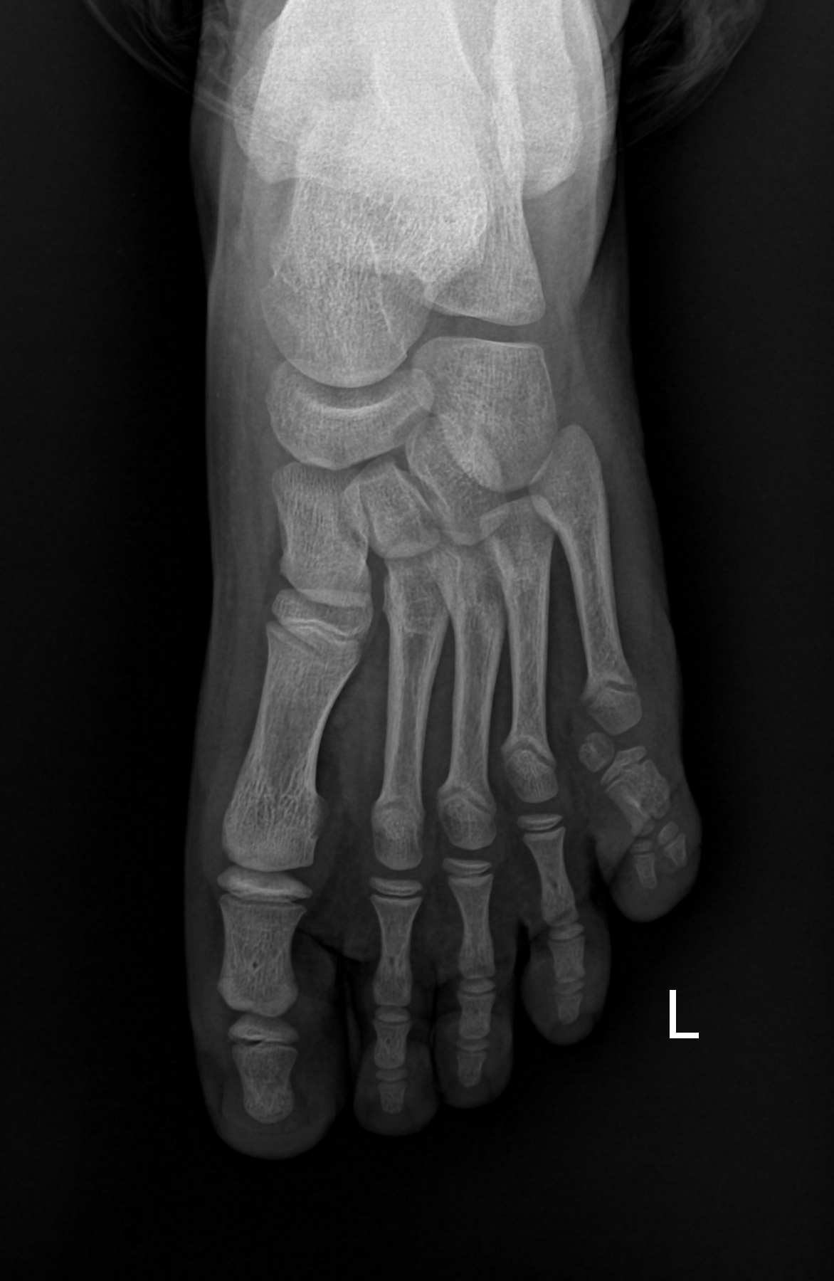 Postaxial Polydactyly - Foot | Image | Radiopaedia.org