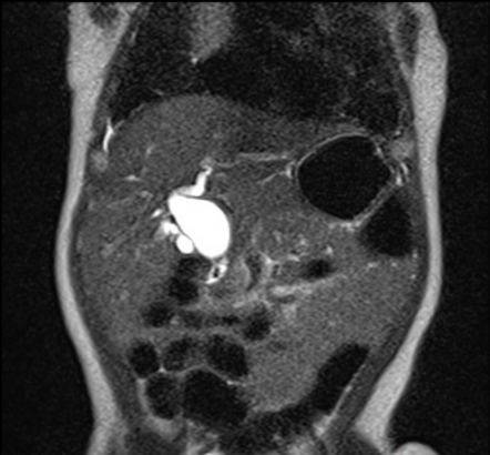 Choledochal Cyst Management