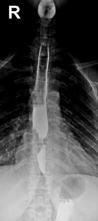 Esophageal cancer - barium swallow | Radiology Case | Radiopaedia.org