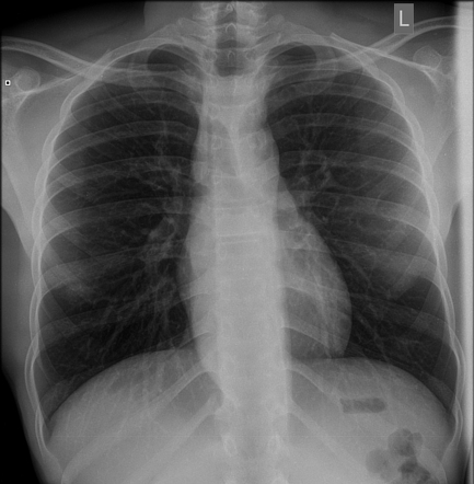 Achalasia | Radiology Case | Radiopaedia.org