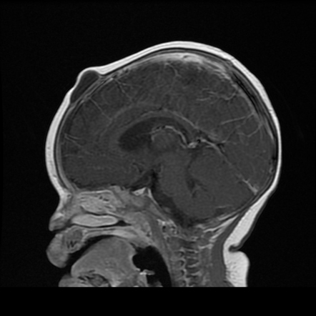 Anterior fontanelle inclusion cyst | Radiology Case | Radiopaedia.org