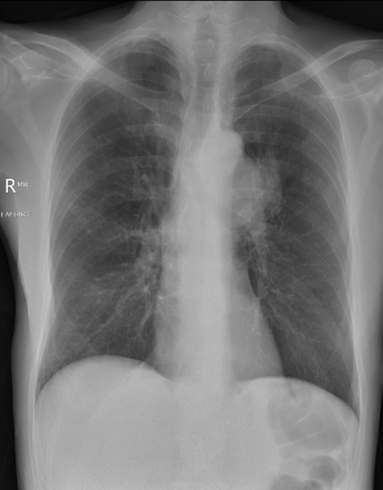 Recurrent laryngeal nerve palsy due to hilar mass | Radiology Case ...