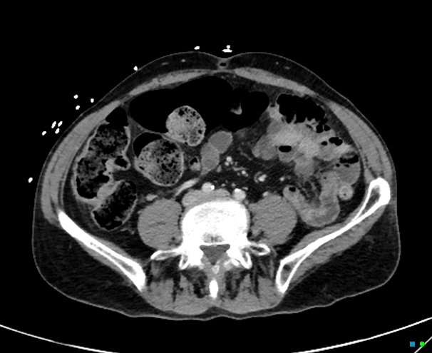 Recurrent Laryngeal Nerve Palsy Due To Hilar Mass 