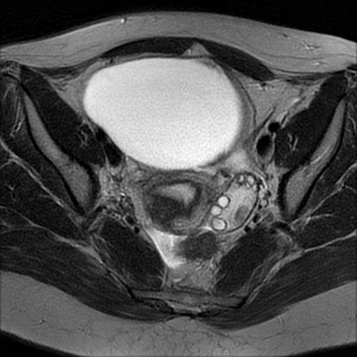 Ovarian Torsion Paratubal Cyst Image