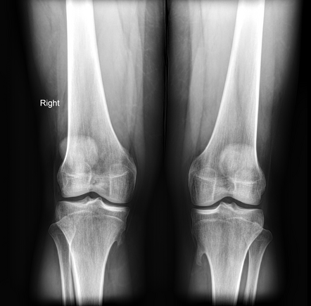 Hereditary multiple exostoses | Radiology Reference Article ...