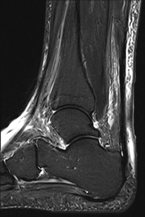 Necrotizing cellulitis and Achilles paratenonitis | Image | Radiopaedia.org