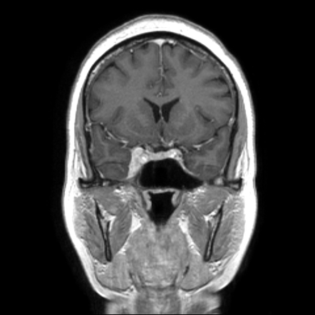 Tolosa-Hunt syndrome | Radiology Case | Radiopaedia.org