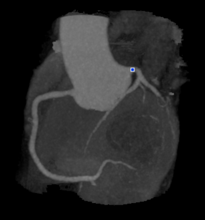 Congenital Absence Of The Circumflex Artery | Image | Radiopaedia.org