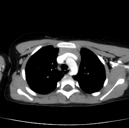 Aberrant Right Subclavian Artery | Radiology Case | Radiopaedia.org