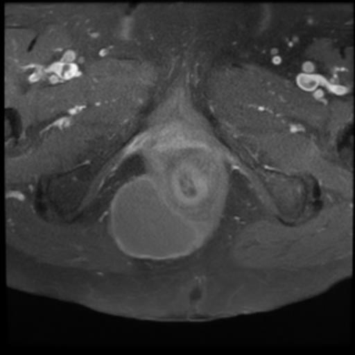 Perineal epidermoid cyst | Image | Radiopaedia.org