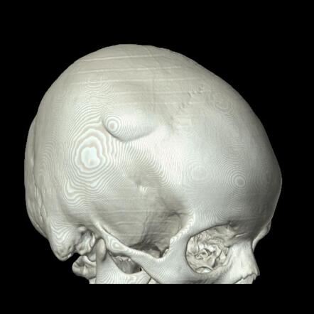 Skull vault osteoma | Radiology Case | Radiopaedia.org