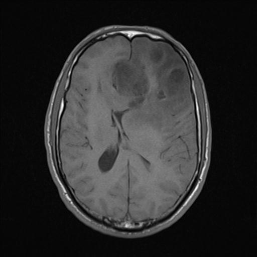 Diffuse astrocytoma NOS | Image | Radiopaedia.org