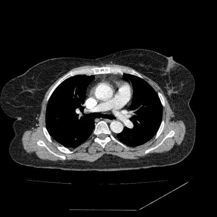 Aortic dissection | Radiology Case | Radiopaedia.org