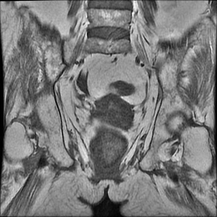 Sacrococcygeal osteomyelitis and abscess | Image | Radiopaedia.org