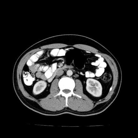 Appendiceal Mucocele | Radiology Case | Radiopaedia.org