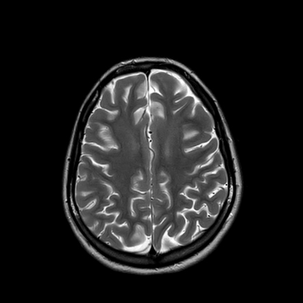 SciELO - Brasil - Niemann-Pick disease type C: a case series of