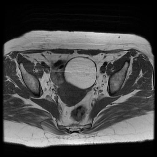 Ovarian Dermoid Cyst Image