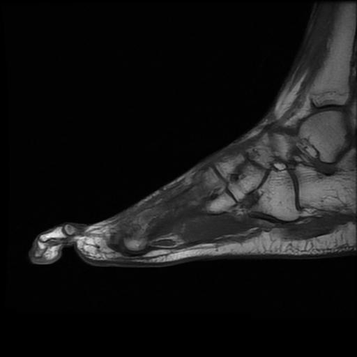 Metatarsal stress fracture | Image | Radiopaedia.org