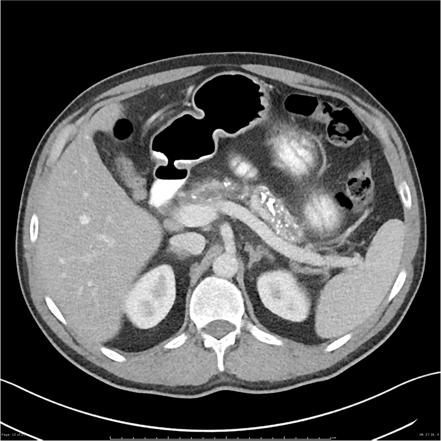 Pancreatic atrophy | Radiology Reference Article | Radiopaedia.org