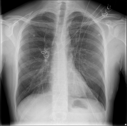 Pneumothorax | Radiology Case | Radiopaedia.org